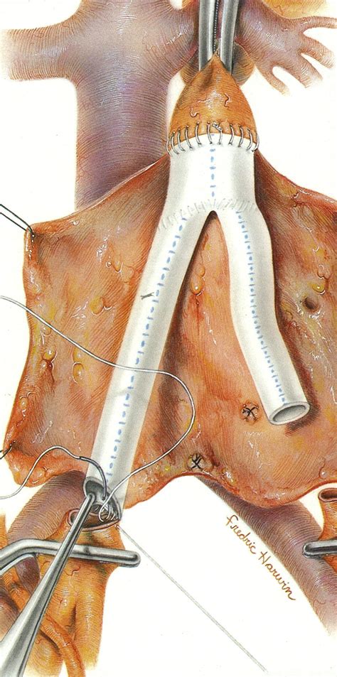 Loop graft gore tex femoral artery